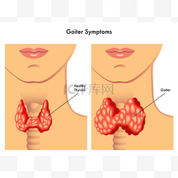 甲状腺卡通图片_详细的人类性甲状腺肿