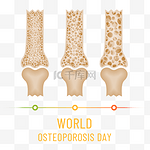 世界骨质疏松日逐渐疏松严重的骨头关节