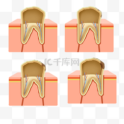 黄牙齿图片_黄牙蛀牙形成过程