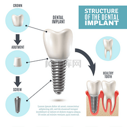 促销医疗图片_牙种植体结构医疗信息图表海报 