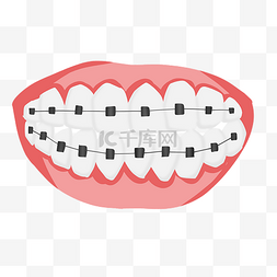 png牙齿图片_戴牙套牙齿矫正
