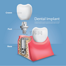 牙齿护理素材图片_人类的牙齿和牙种植体矢量图