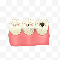 牙齿牙图片_蛀牙坏牙形成过程