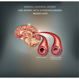 动脉硬化指数图片_健康和不健康的脑动脉