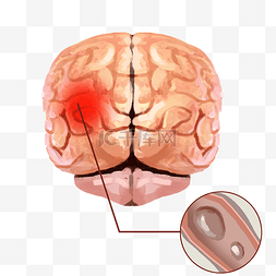 中风诱因图片_大脑脑袋中风