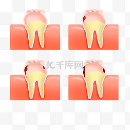 虫牙图片_蛀牙形成过程