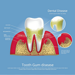 假牙清洁图片_人类牙齿阶段的牙龈疾病媒介图解