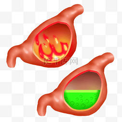 人体胃酸胃热