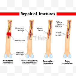 骨骨折愈合过程