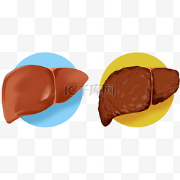 脂肪和盐图片_人体脏器肝硬化