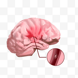 脑卒中康复训练图片_脑疾病脑中风