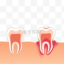 牙齿发炎牙周炎