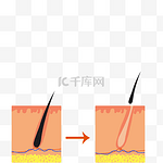 头皮植发生发