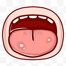 口腔健康保护牙齿扁平口腔溃疡医学粘膜炎症口腔疾病口腔溃疡口腔溃疡