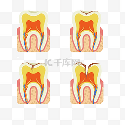 虫牙图片_人体蛀牙形成过程