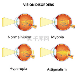 eye图片_Common vision disorders.