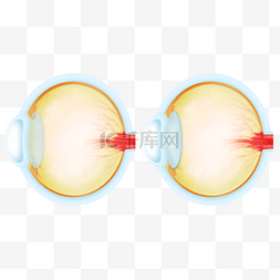 医疗健康医疗图片_白内障医疗健康医疗健康眼科眼睛