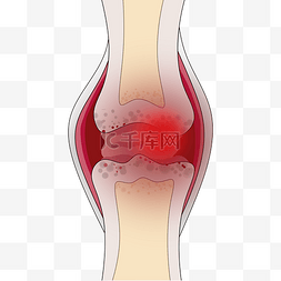 人体腿部关节炎