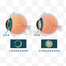 模糊检索图片_白内障爱眼眼病眼科眼睛疾病医疗