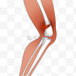 腿部筋骨图片_腿部骨头骨折