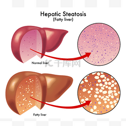 卡通肝图片_肝脂肪变性