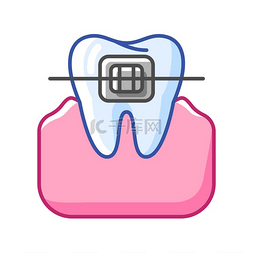 牙套的插图。