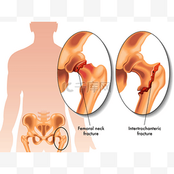 背景医药图片_人类股骨骨折