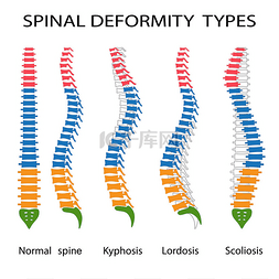 畸形元素图片_脊柱畸形类型.