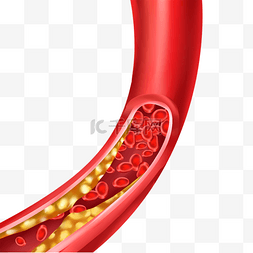 颈动脉硬化示意图图片_人体血管医学血管阻塞插图