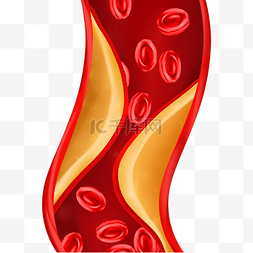 脂肪胆固醇图片_血管堵塞血液不能流动