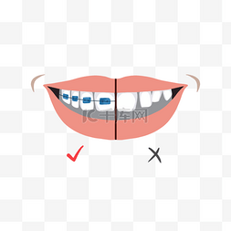 钢牙套图片_牙套矫正牙齿效果对比