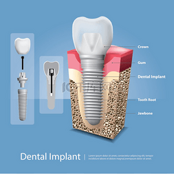 牙口腔护理图片_人类的牙齿和牙种植体矢量图