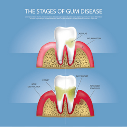 假牙清洁图片_人类牙齿阶段的牙龈疾病媒介图解