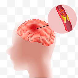 生病人物图片_生病人物中风