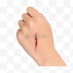 我用残损的手掌图片_手掌划伤伤口