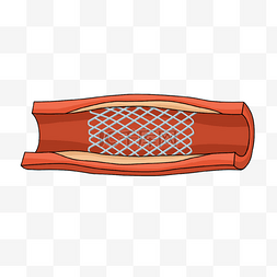 已经完成图片_心脏病学放置完成的动脉支架插画