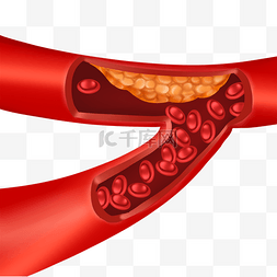 静脉图片_血管堵塞动脉硬化