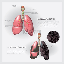 肺部吸氧图片_肺部细节和肺癌症载体插图