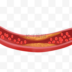 颈动脉硬化示意图图片_心血管堵塞