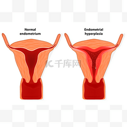 子宫解剖图片_子宫内膜增生过长