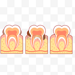 人体病变图片_人体牙齿病变过程