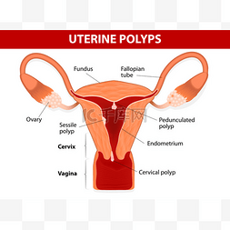女性结构图片_子宫内膜息肉、 子宫内膜息肉