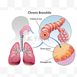慢性支气管炎