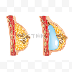 隆鼻图标图片_隆胸示意图。元素在一个单独的层