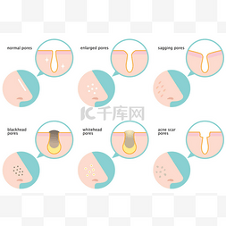 鼻部皮肤毛孔集: 正常、下垂、肿
