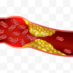 动脉血管堵塞图片_血管堵塞动脉硬化
