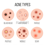 创意向量插图类型痤疮, 丘疹, 皮肤毛孔, 黑头, 白石, 疤痕, 粉刺, 阶段图隔离在透明的背景。艺术设计。抽象概念图形元素