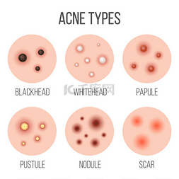 创意向量插图类型痤疮, 丘疹, 皮