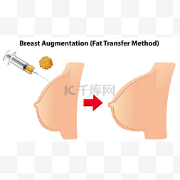 丰胸脂肪转移方法例证