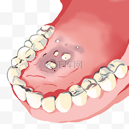 口腔健康图片_口腔溃疡病症
